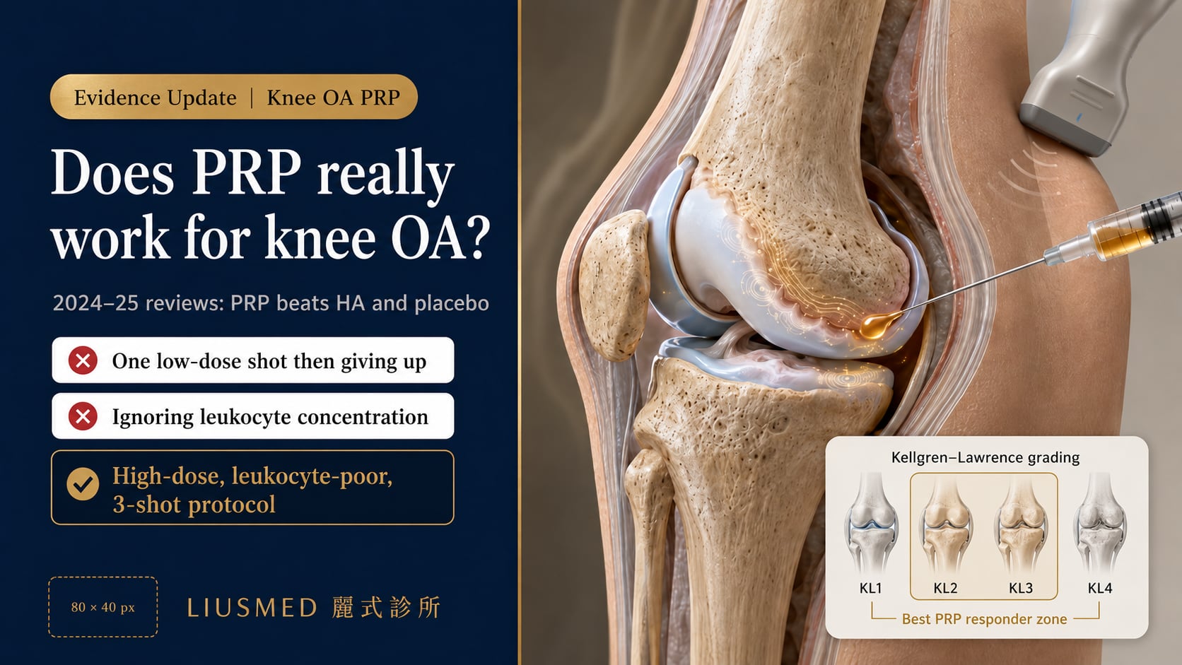 PRP for Knee Osteoarthritis: 2026 Evidence, Dosage & Advice